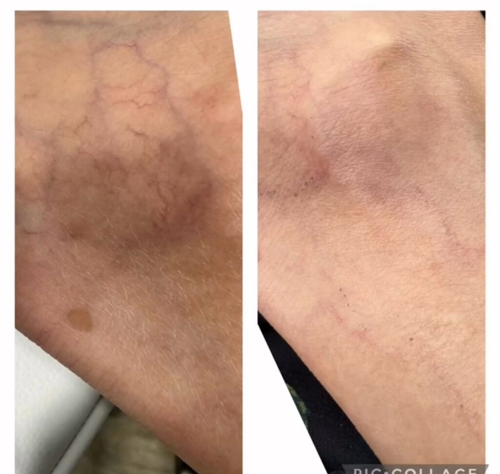 ADVA Laser: Before and After