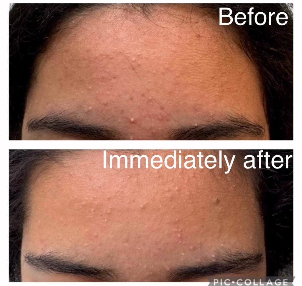 ADVA Laser: Before and After