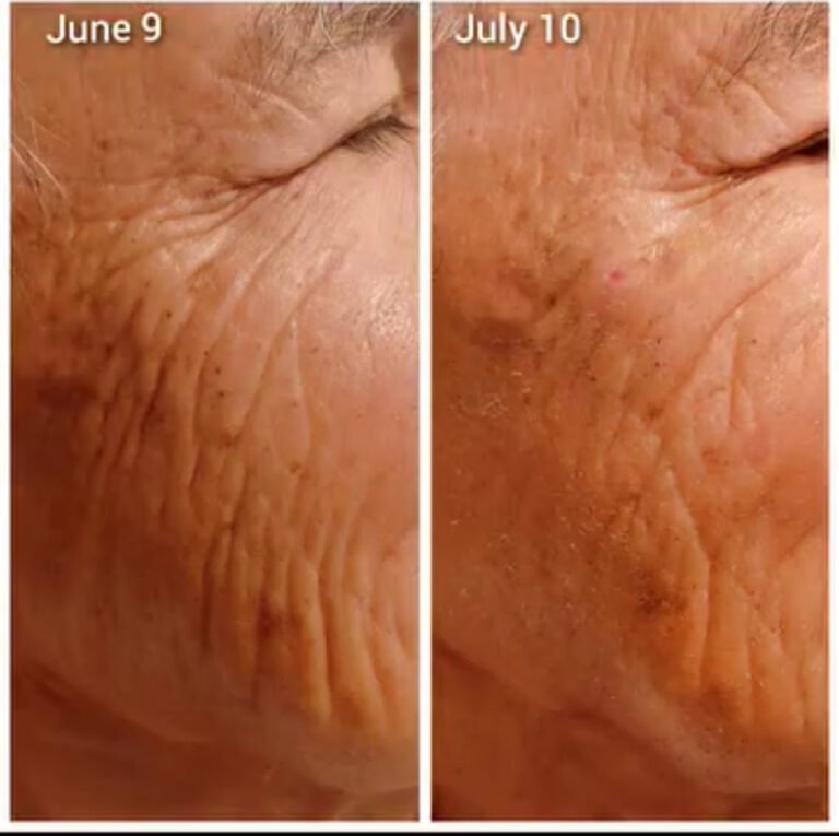 ADVA Laser: Before and After