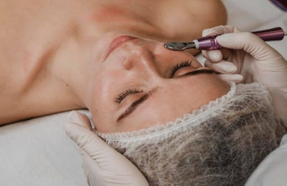 microneedling