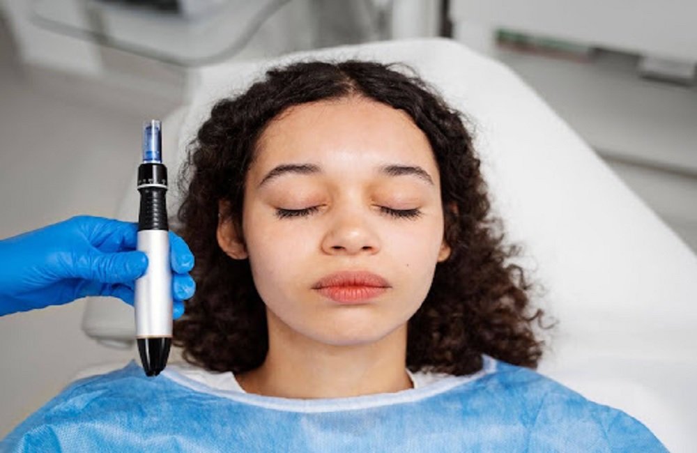 Potenza RF Microneedling